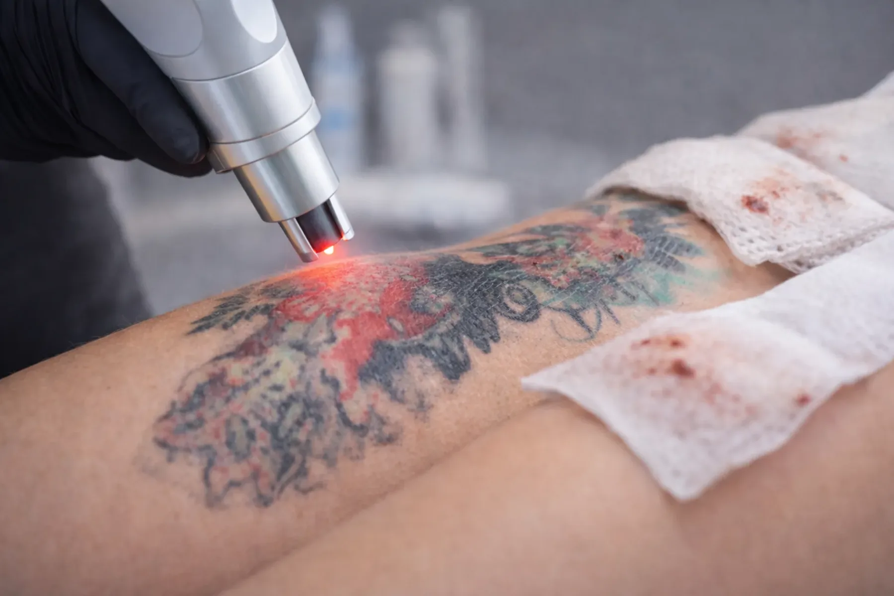 Close up van laserbehandeling waarbij een tattoo op de arm wordt behandeld, met gaasjes op de huid en een laserhandstuk boven het pigment.