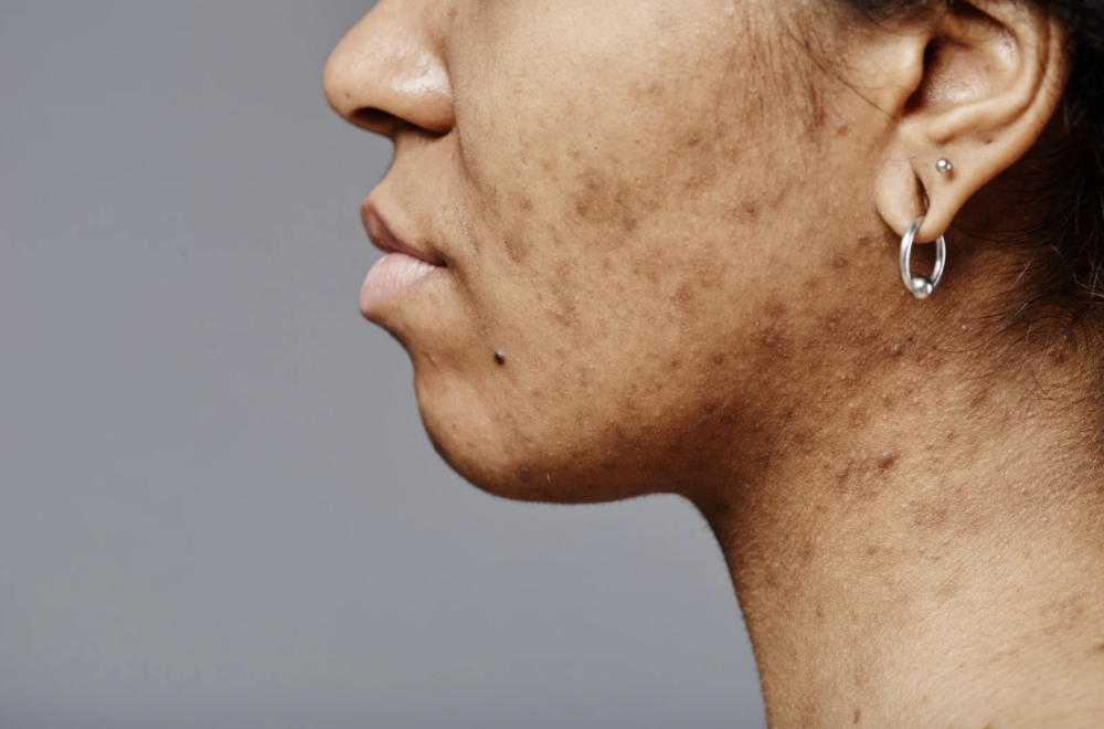 Acne laseren Almere, acnelittekens vervagen