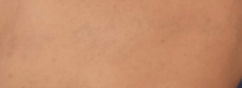 Na — Voor en na tattoo verwijderen Almere, PicoWay laser