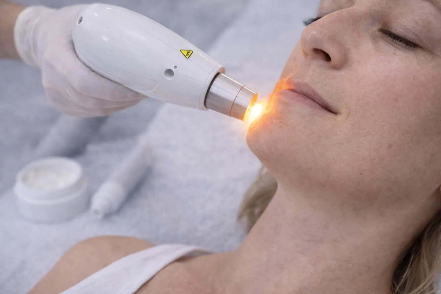 Laserbehandeling op de bovenlip in een kliniek, met een laserhandstuk op de huid en een warme flits tijdens de sessie.