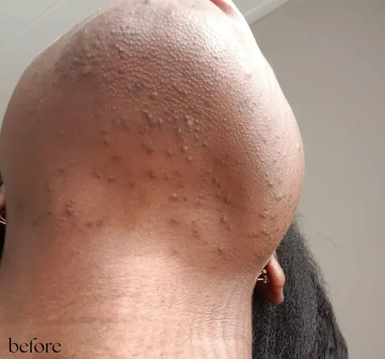 Voor — Voor en na tattoo verwijderen Almere, PicoWay laser